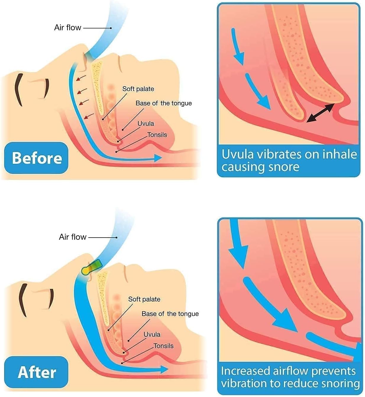 Anti Snoring Nose Clip