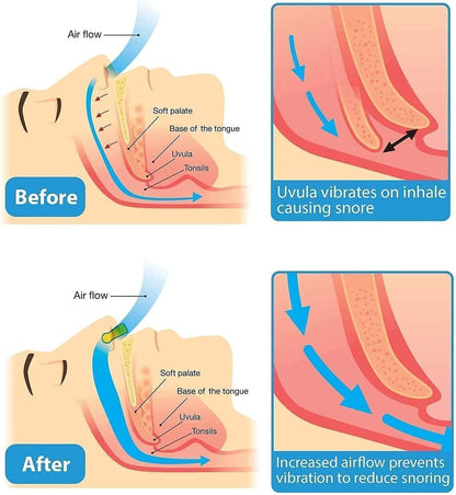 Anti Snoring Nose Clip